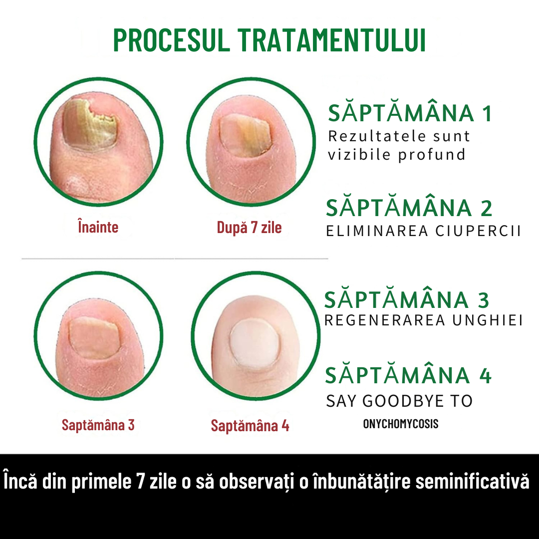 Ser împotriva ciupercilor unghiilor