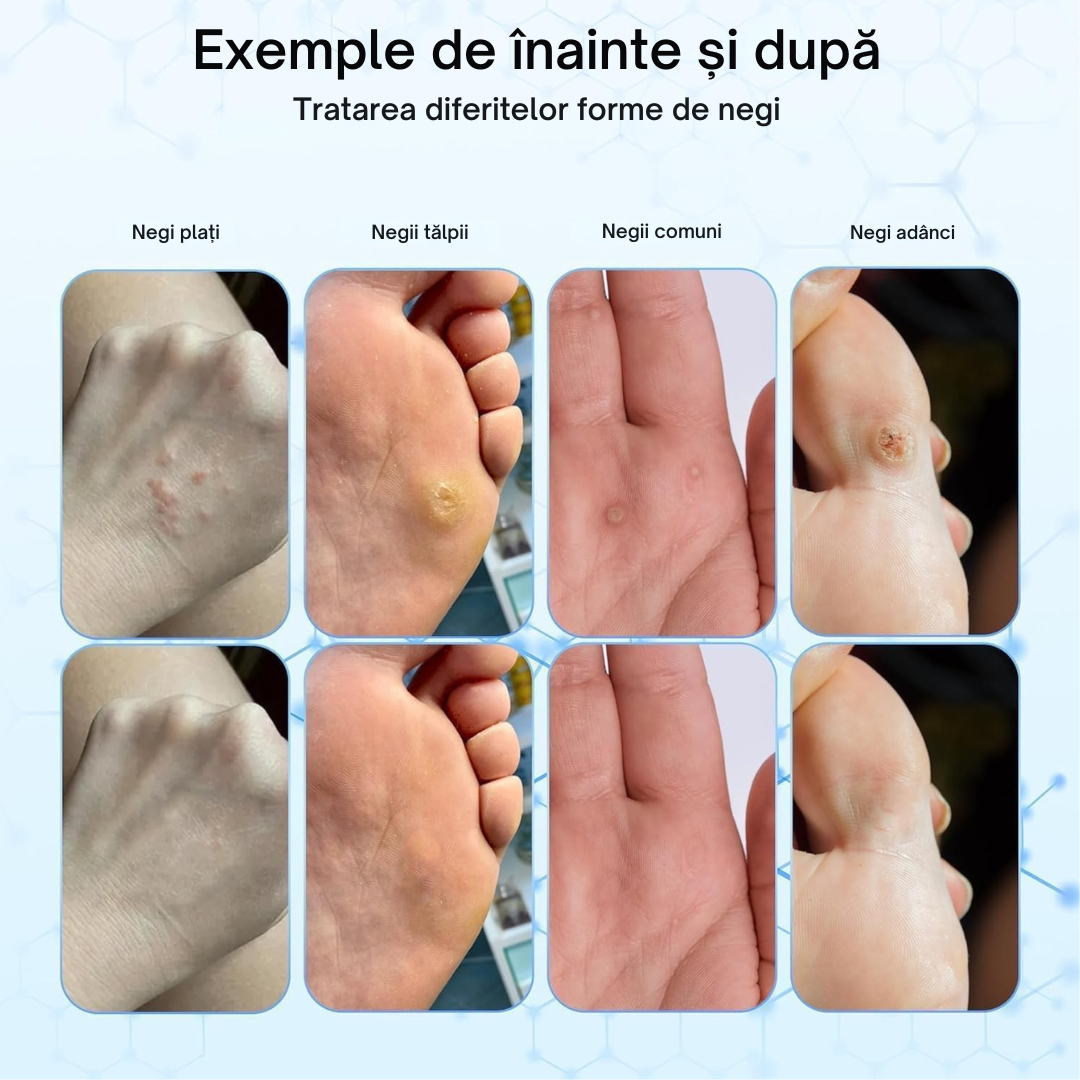 Dispozitiv profesional anti-negi