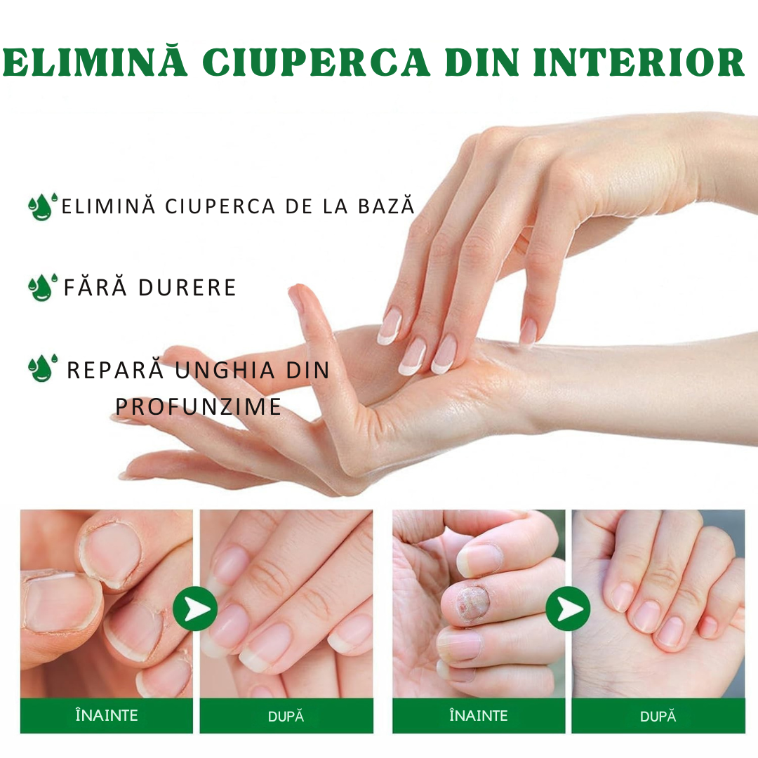 Ser împotriva ciupercilor unghiilor